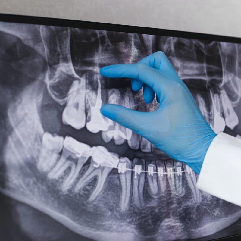 Doctor points to filled root canal in dental x-ray